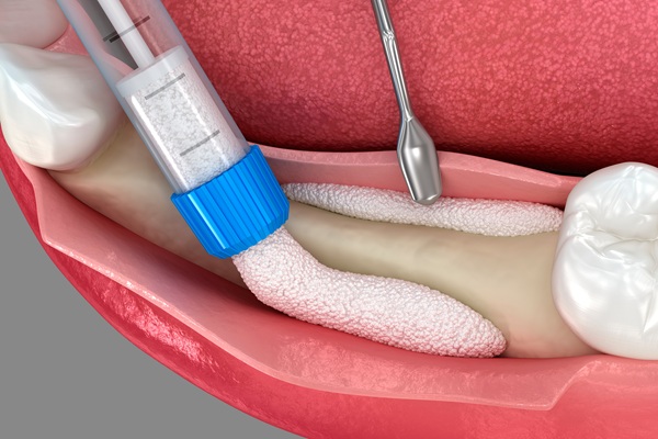 FAQs: Bone Graft For Dental Implants