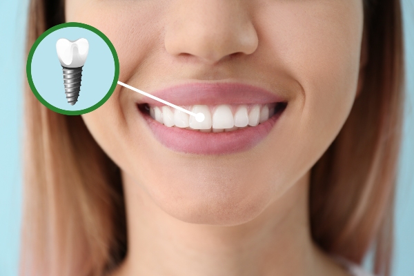 Dental Implant: A Periodontist’s Guide To Restoring Your Smile
