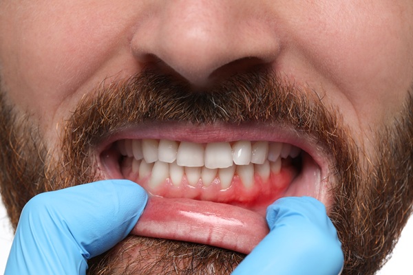 The Most Effective Options For Gum Recession Treatment